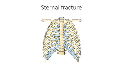 Sternum Fracture Treatment Sternum Bone Fracture Surgery