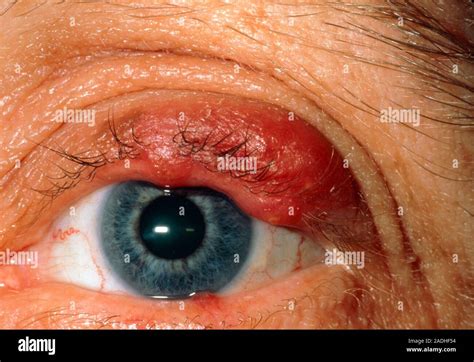 Meibomian Cyst Close Up Of An Adult Patients Eye Showing A Reddish