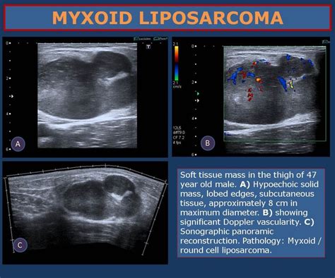 Ecr 2013 C 1867 High Resolution Ultrasound In The Assessment Of