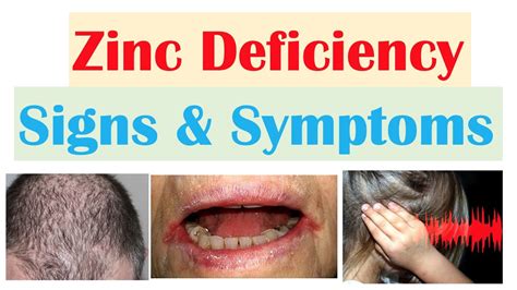 Zinc Deficiency Signs And Symptoms Ex Hair Loss Acne Infections And Why They Occur Youtube