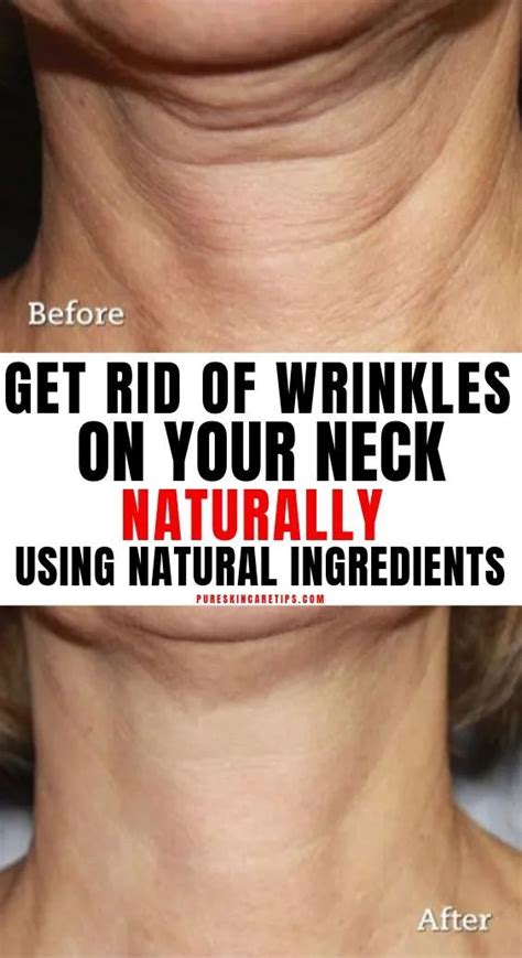 Learn How To Get Rid Of Wrinkles On Neck Naturally Using Ingredients