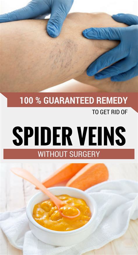 100 Guaranteed Remedy To Get Rid Of Spider Veins Without Surgery Spider Veins Get Rid Of