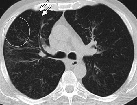 Lung And Pleura Radiology Key