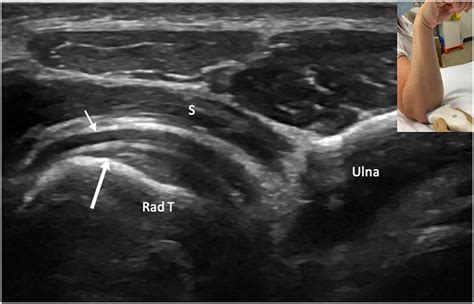 Distal Biceps Tendon Ultrasound