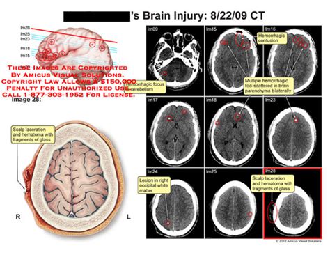 AMICUS Illustration Of Amicus Injury Brain CT Scalp Laceration Hematoma