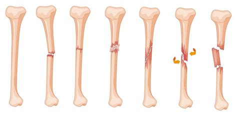 Tibia Fractures Types Symptoms And Treatments Heiden Orthopedics