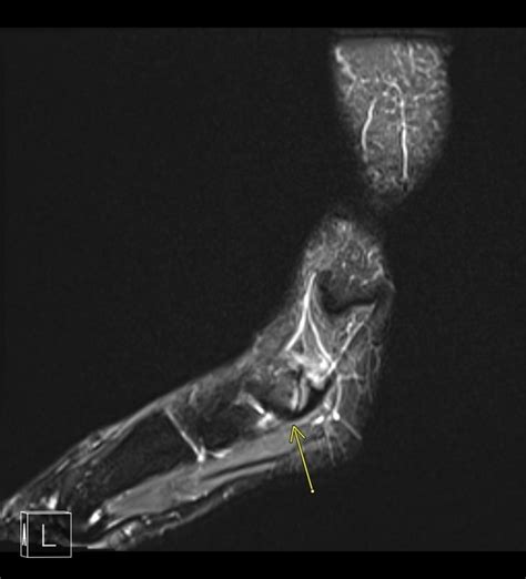 Accessory Navicular Syndrome Pacs