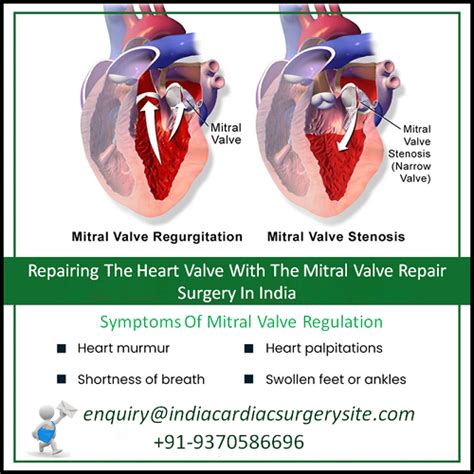 Repairing The Heart Valve With The Mitral Valve Repair Surgery In India