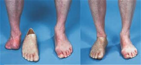 Prosthetic Partial Foot Amputation Google Search Prosthetics Feet