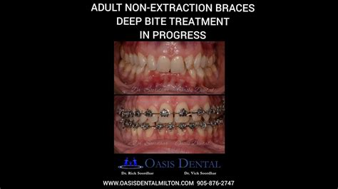 Adult Non Extraction Braces Deep Bite And Tmj Disorder Treatment Alf Orthodontics Youtube