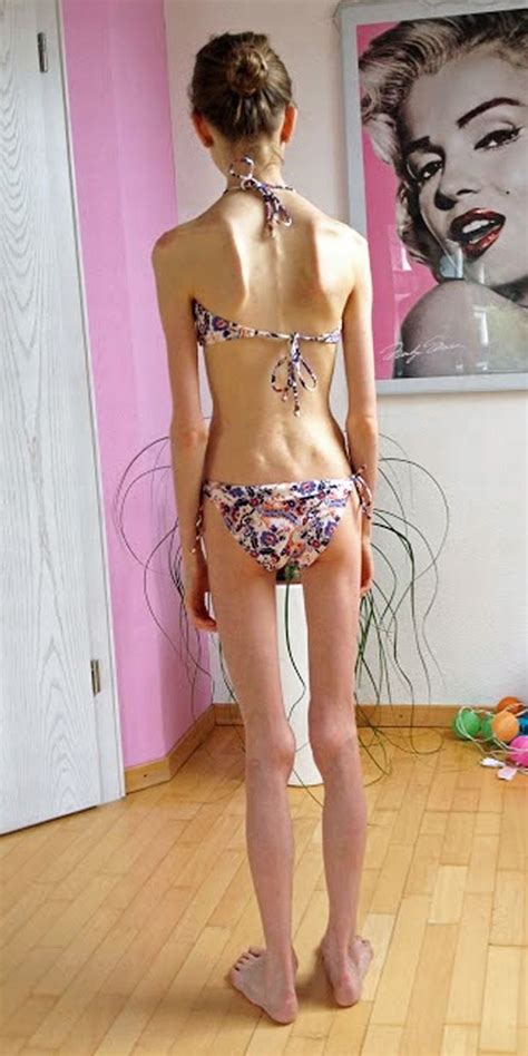 Super Skinny Anorexic Girls Nude Telegraph