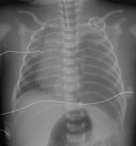 Chylothorax After Repair Of Congenital Diaphragmatic Hernia In A