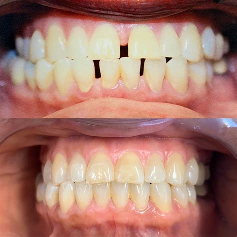 Invisalign Before And After Gapped Teeth Evevirt