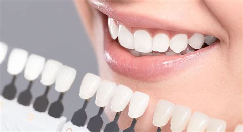 We Know White Fillings And What You Need Regent Dental Practice