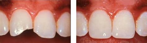 Composite Resin Restorations Keri Shenker Dentistry