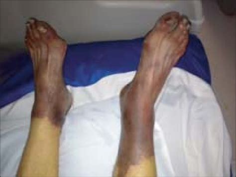 Gangrene Of Both Feet Download Scientific Diagram