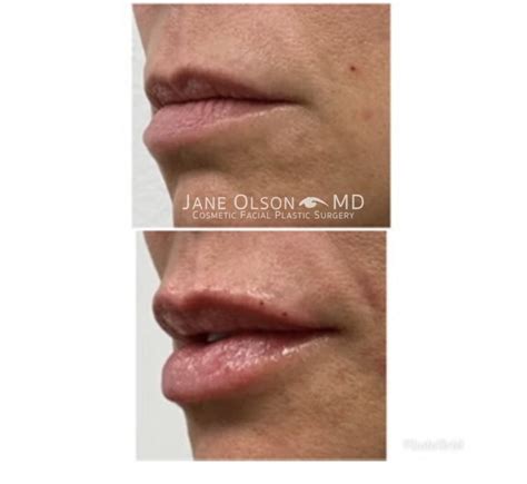 Before And After Results Gallery Jane Olson Md