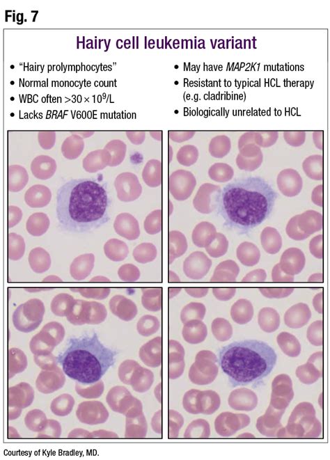 Hairy Cell Variant Leukemia