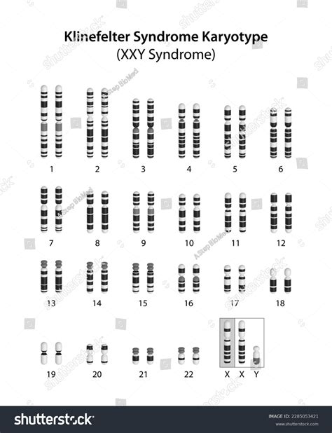 Klinefelter Syndrome Xxy Syndrome Karyotype Stock Illustration