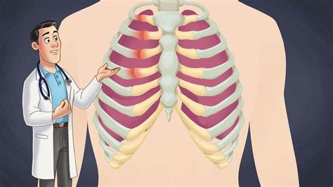 What Is Costochondritis Symptoms Causes Treatment Healthy Magazine