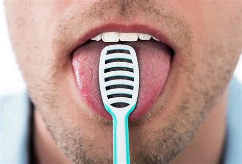 Black Hairy Tongue Symptoms Causes And Treatment