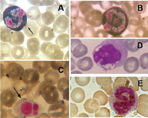 Stained Blood Films Showing Intensive Basophilic Cytoplasm With