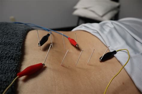 Trigger Point Dry Needling Colorado Institute Of Sports Medicine