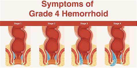 Grade Iv Hemorrhoid Grade 2 Internal Hemorrhoid Pictures Bojler