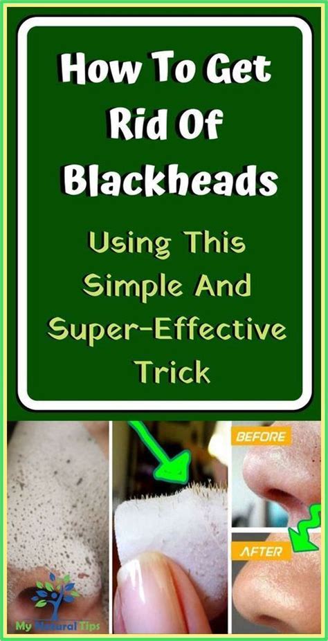 Use This Simple And Super Effective Trick And Get Rid Of Blackheads