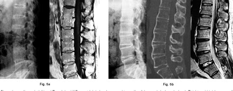 Figure 5 From The Andersson Lesion In Ankylosing Spondylitis