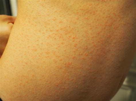 What Is Causing This Pruritic Rash On An Adolescent Boy Consultant360