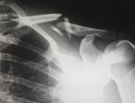 Clavicle Fractures Fracture Healing