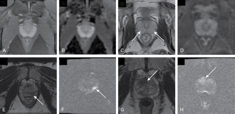 Prostate Imaging Radiology Key
