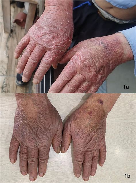 Frontiers Clearance Of Chronic Actinic Dermatitis With Dupilumab