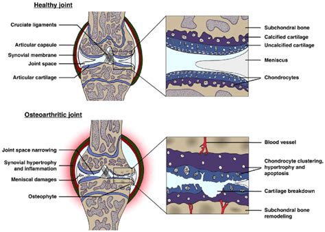 Joint Tissue Affections In Knee Osteoarthritis Oa Reprinted From
