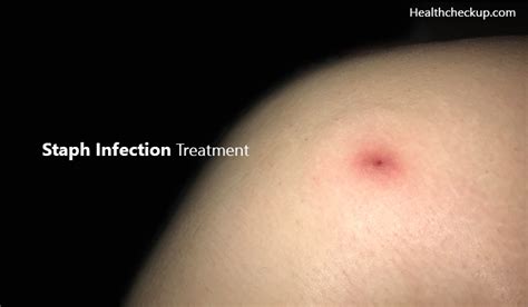Staph Infection Treatment Symptoms Of Staph Infection Health Checkup