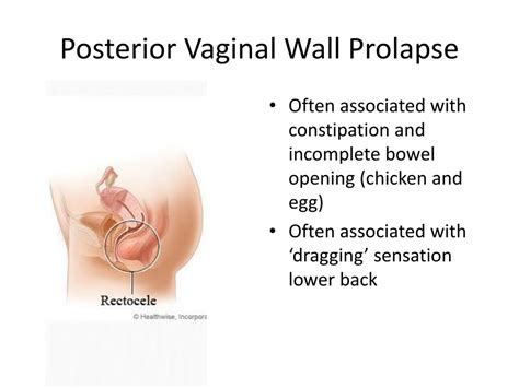 Ppt Female Pelvic Organ Prolapse Powerpoint Presentation Free Download Id