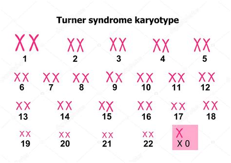 Turner Syndrom Karyotyp Stock Vector By Zuzanaa