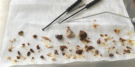 Clumps Of Mans Earwax Removed After 16 Years Of Buildup Fox News