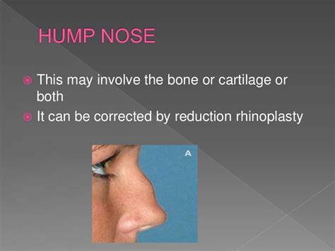 Diseases Of External Nose