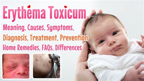 Erythema Toxicum Overview Causes Sign And Symptoms Treatment