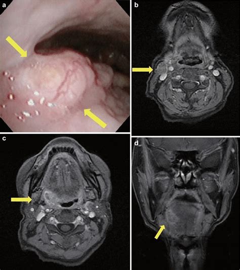 Case 1 A Oropharyngeal Fiberscopic Image A Tumor Was Observed In The