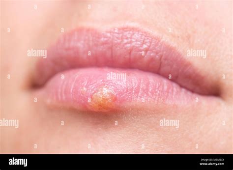 Cold Sore On Lower Lip