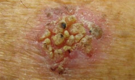What Is Actinic Keratosis Lesions Photos Dorothee Padraig South West Skin Health Care