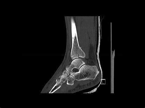 Ankle Fracture Posterior Malleolar Fixation Using A Posteromedial Approach Surgical Technique