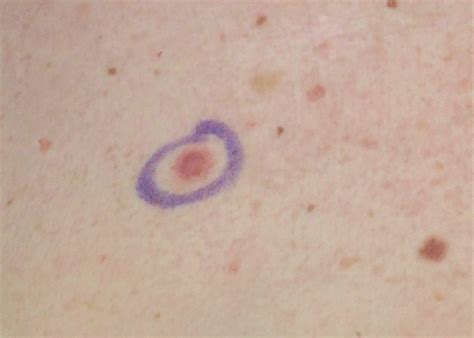 Small Melanoma Pictures Symptoms And Pictures