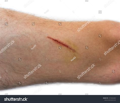 Wound On Human Body Suture Old Stock Photo Edit Now 1072652462
