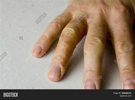Closeup Eczema Image And Photo Free Trial Bigstock