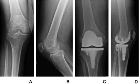 Tibial Plateau Fractures In Elderly Patients Joshua C Rozell
