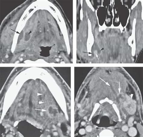 Oral Cavity Infectious And Noninfectious Inflammatory Conditions